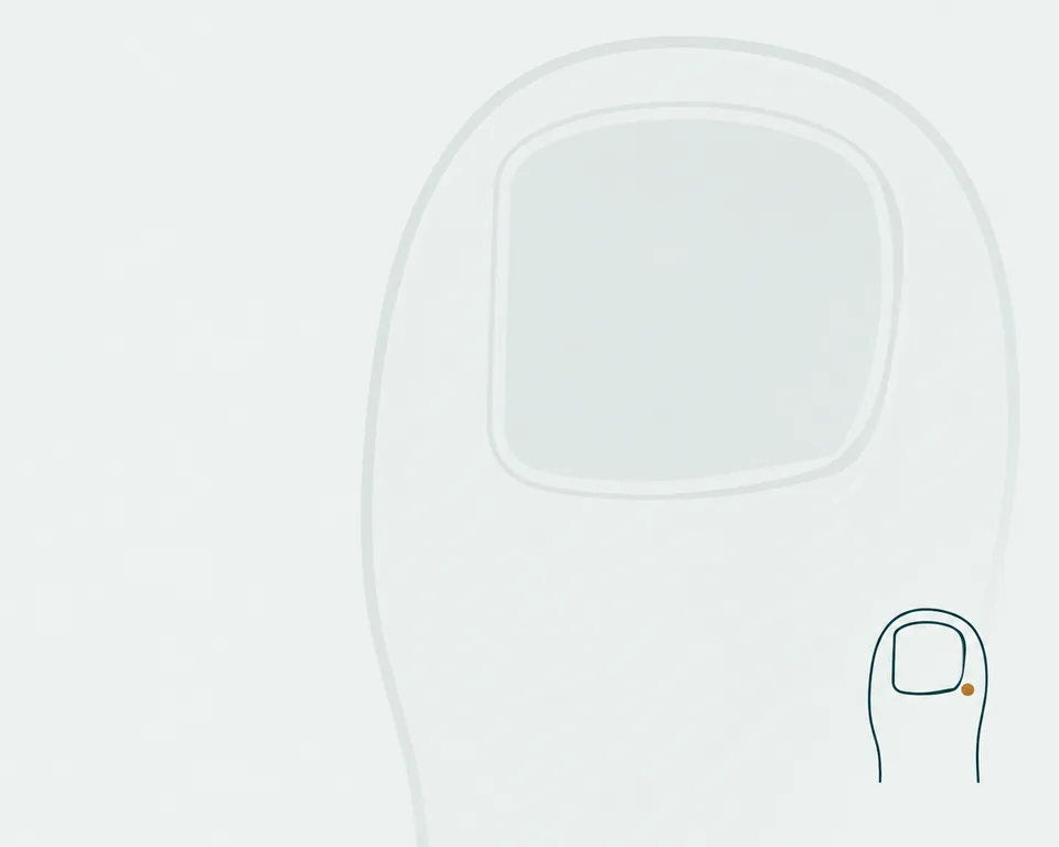 Decorative branded panel for ingrown toenails